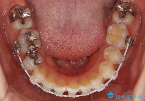 前歯のガタつきを改善 抜歯矯正後の後戻りの治療中