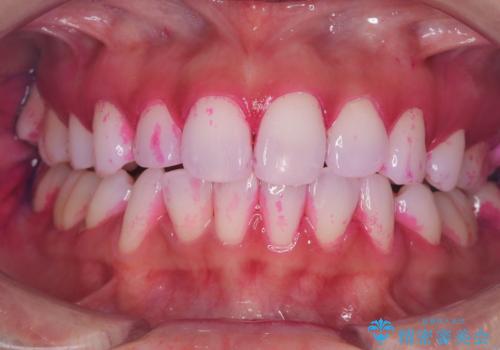 白い歯、健康な歯は、クリーニングからの症例 治療前