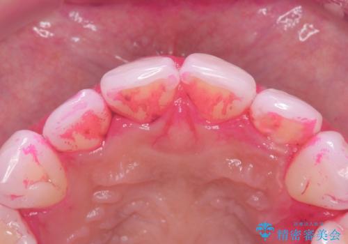 白い歯、健康な歯は、クリーニングからの治療前
