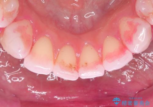 白い歯、健康な歯は、クリーニングからの治療前