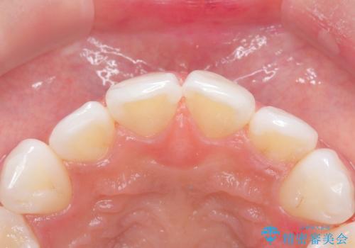 白い歯、健康な歯は、クリーニングからの治療後