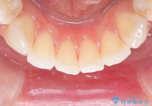 白い歯、健康な歯は、クリーニングからの治療後