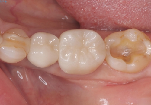 銀歯を白くしたい セラミックインレーの治療中