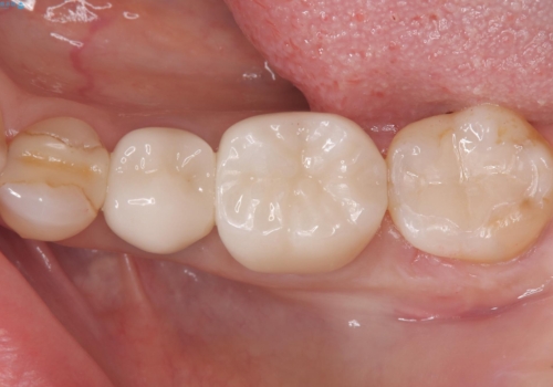 銀歯を白くしたい セラミックインレーの治療後