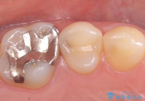 セラミックインレー 虫歯の治療の治療前