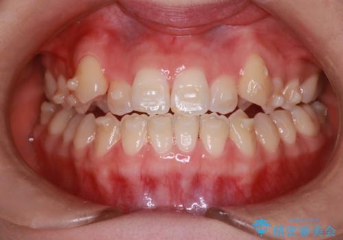 MARPEで非抜歯矯正|オープンバイトと八重歯を改善の治療中