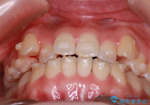 MARPEで非抜歯矯正|オープンバイトと八重歯を改善の治療中
