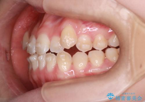 MARPEで非抜歯矯正|オープンバイトと八重歯を改善の治療中