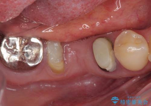 放置していたむし歯 抜歯即時埋入インプラントによる補綴治療の治療前