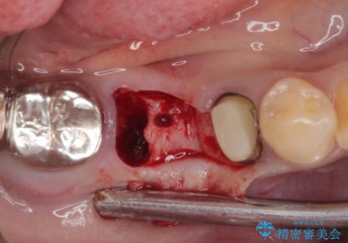 放置していたむし歯 抜歯即時埋入インプラントによる補綴治療の治療中