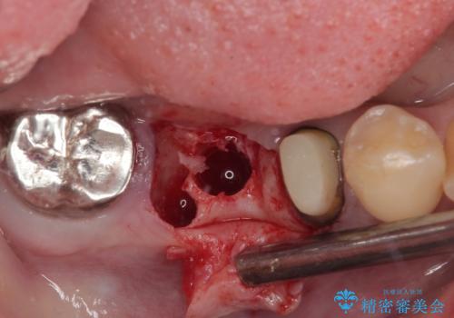 放置していたむし歯 抜歯即時埋入インプラントによる補綴治療の治療後