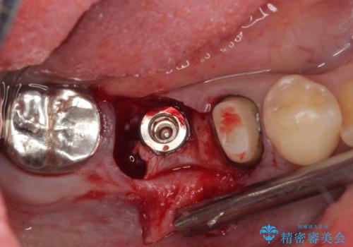 放置していたむし歯 抜歯即時埋入インプラントによる補綴治療の治療中