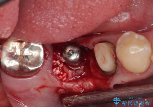 放置していたむし歯 抜歯即時埋入インプラントによる補綴治療の治療中