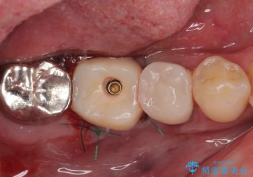 放置していたむし歯 抜歯即時埋入インプラントによる補綴治療の治療後