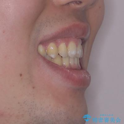 口が閉じられない 抜歯矯正で前歯の突出感を改善の治療後(顔貌)