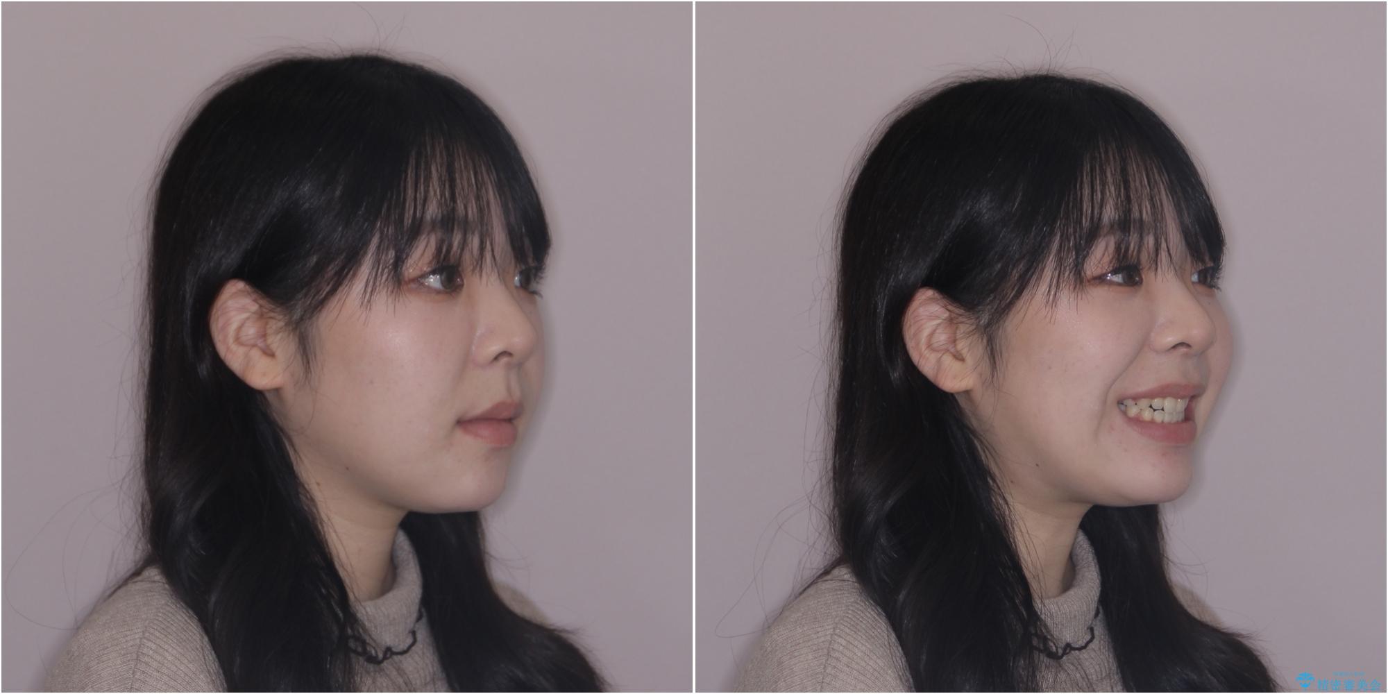 【モニター】舌突出癖で隙間が ワイヤー装置での抜歯矯正の治療後(顔貌)