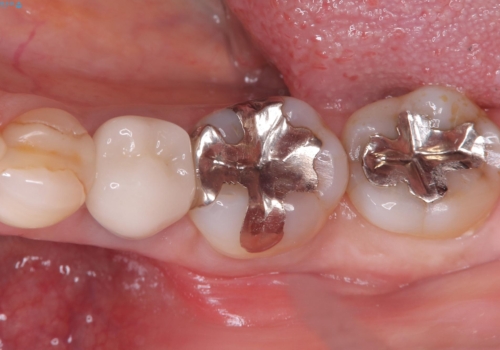 銀歯を白くしたい セラミックインレーの治療前