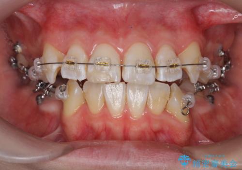 突き出た前歯を治したい 小臼歯抜歯+マルチブラケット矯正の治療前