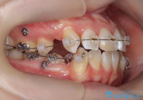 突き出た前歯を治したい 小臼歯抜歯+マルチブラケット矯正の治療前