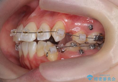 突き出た前歯を治したい 小臼歯抜歯+マルチブラケット矯正の治療前