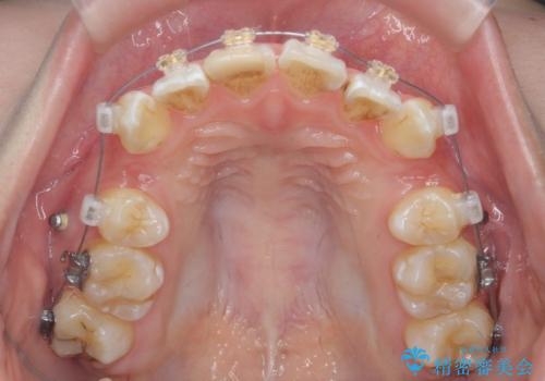 突き出た前歯を治したい 小臼歯抜歯+マルチブラケット矯正の治療前