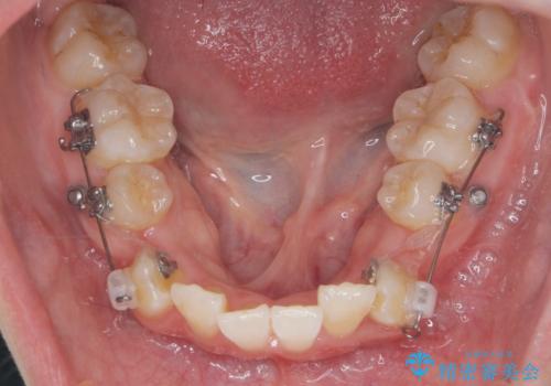 突き出た前歯を治したい 小臼歯抜歯+マルチブラケット矯正の治療前