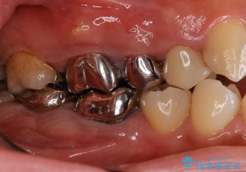 奥歯のインプラント治療の治療前