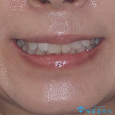 前歯のデコボコとむし歯治療の跡 インビザライン矯正とオールセラミッククラウン治療の治療前(顔貌)