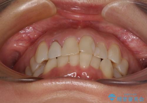 前歯のデコボコとむし歯治療の跡 インビザライン矯正とオールセラミッククラウン治療の治療前