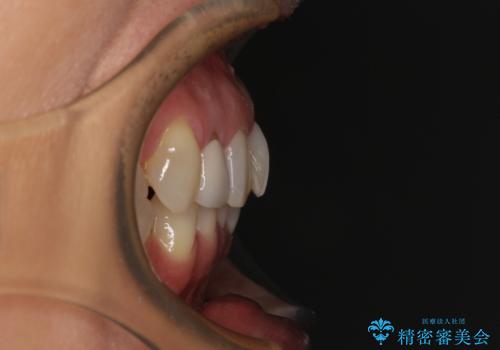 前歯のデコボコとむし歯治療の跡 インビザライン矯正とオールセラミッククラウン治療の治療前