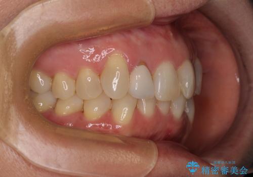 前歯のデコボコとむし歯治療の跡 インビザライン矯正とオールセラミッククラウン治療の治療前