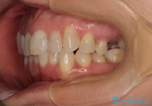 前歯のデコボコとむし歯治療の跡 インビザライン矯正とオールセラミッククラウン治療の治療前