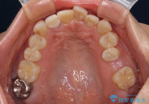 前歯のデコボコとむし歯治療の跡 インビザライン矯正とオールセラミッククラウン治療の治療前