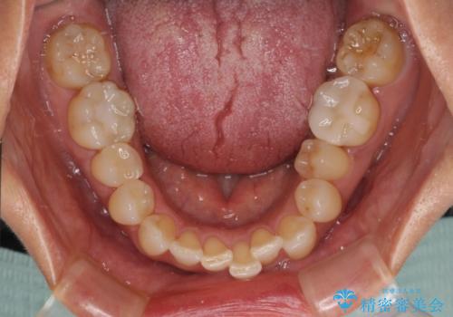 前歯のデコボコとむし歯治療の跡 インビザライン矯正とオールセラミッククラウン治療の治療前