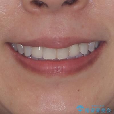 前歯のデコボコとむし歯治療の跡 インビザライン矯正とオールセラミッククラウン治療の治療後(顔貌)