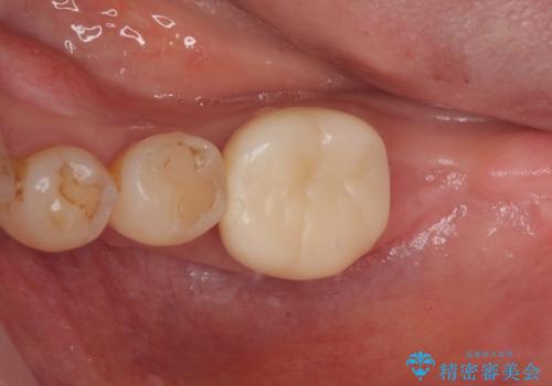 骨よりも深く進行したむし歯 即時荷重インプラントでの短期間治療の治療中