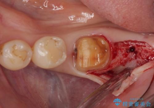 骨よりも深く進行したむし歯 即時荷重インプラントでの短期間治療の治療中