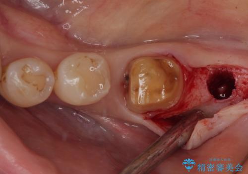 骨よりも深く進行したむし歯 即時荷重インプラントでの短期間治療の治療後