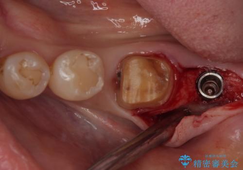 骨よりも深く進行したむし歯 即時荷重インプラントでの短期間治療の治療前