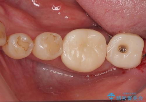 骨よりも深く進行したむし歯 即時荷重インプラントでの短期間治療の治療中