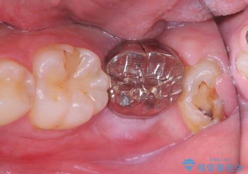痛くないインプラント治療|1回の手術で終了!|エンドペリオ病変|オールセラミッククラウンの治療前