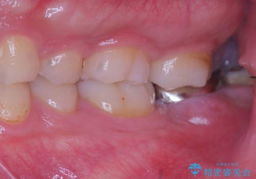 痛くないインプラント治療|1回の手術で終了!|エンドペリオ病変|オールセラミッククラウンの症例 治療前