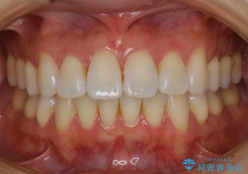 再矯正の症例 治療前