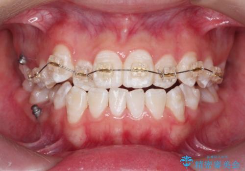 上下すれ違った前歯の矯正治療の治療前
