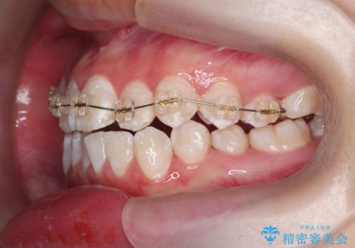 上下すれ違った前歯の矯正治療の治療前