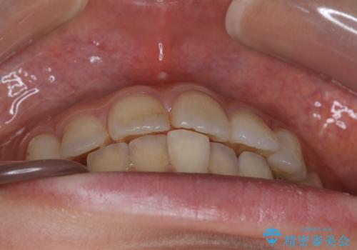 前歯のガタつきを改善 抜歯矯正後の後戻りの治療前