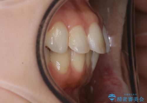 前歯のガタつきを改善 抜歯矯正後の後戻りの治療前