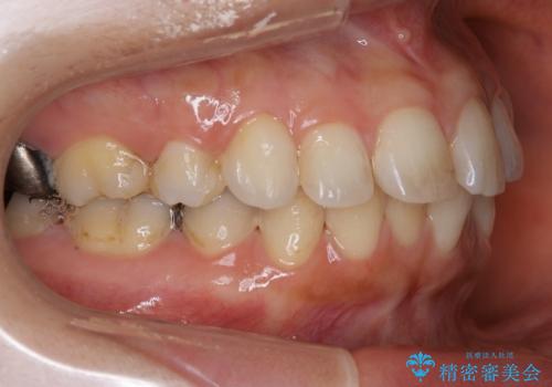 前歯のガタつきを改善 抜歯矯正後の後戻りの治療前