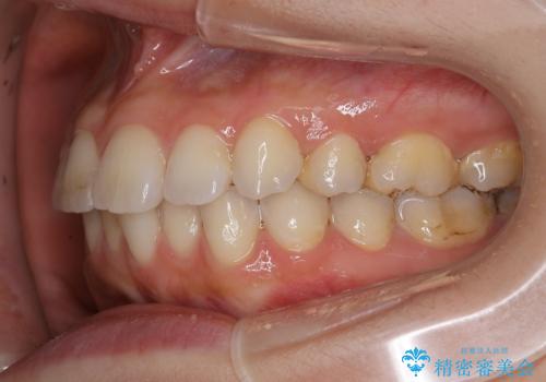 前歯のガタつきを改善 抜歯矯正後の後戻りの治療前