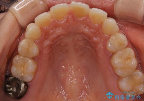 前歯のガタつきを改善 抜歯矯正後の後戻りの治療前